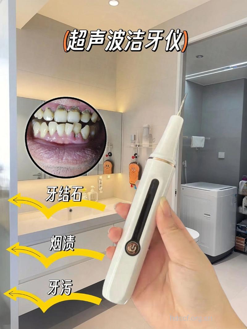 超声波洁牙你了解多少
