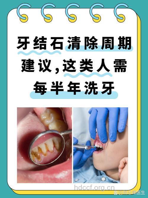 牙齿漂白能消除牙石吗