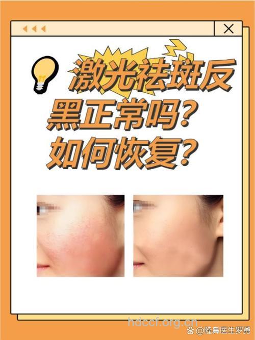 激光祛斑会反弹吗