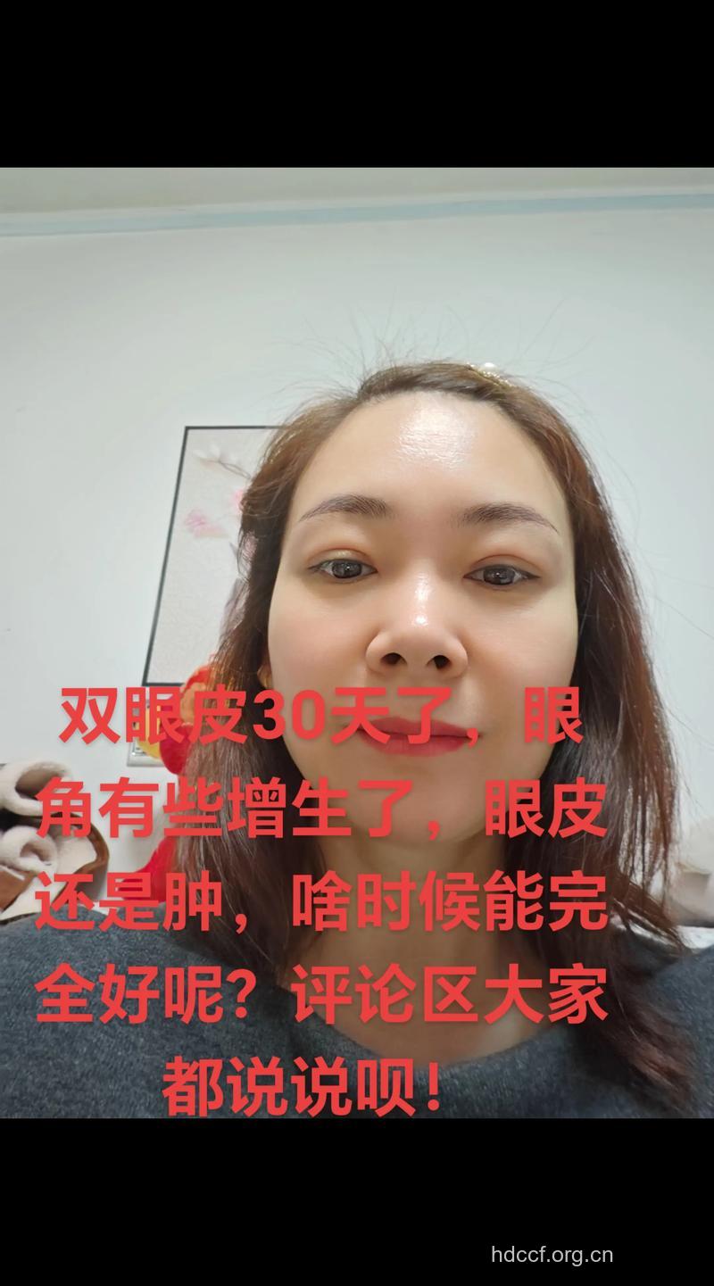 割双眼皮后怎么让眼睛更快消肿