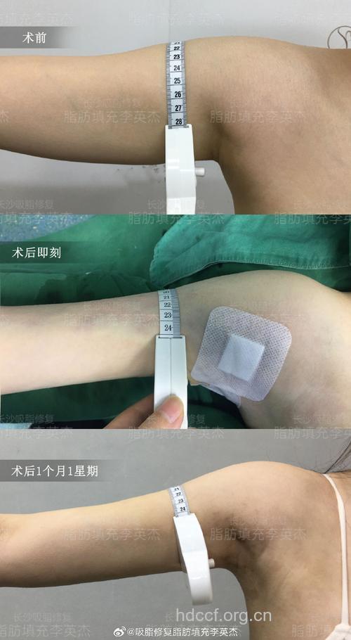 手臂吸脂手术前的准备
