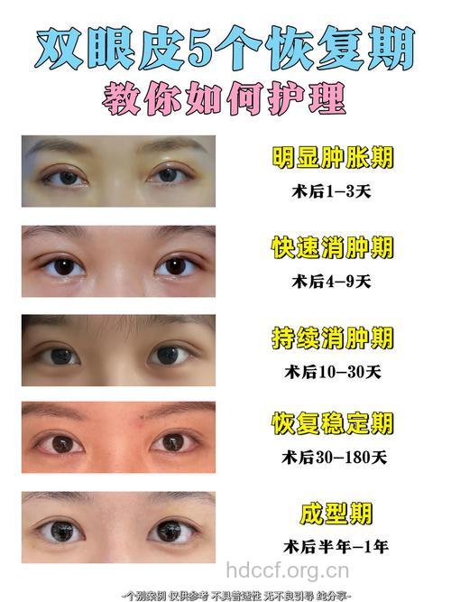 割双眼皮多久才能消肿