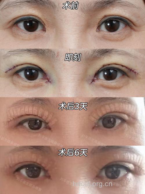 什么是下脸松弛整形术