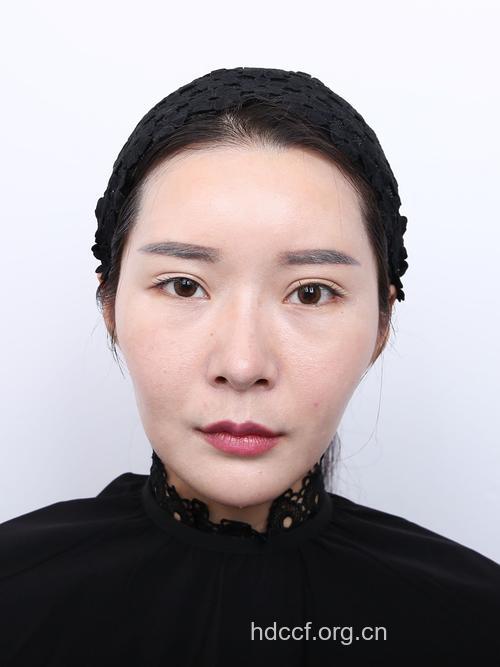 颧骨正整形术前术后建议
