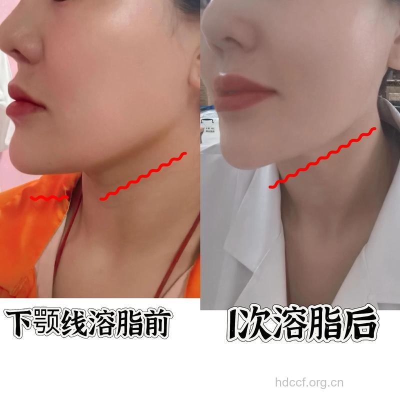 下巴吸脂效果如何