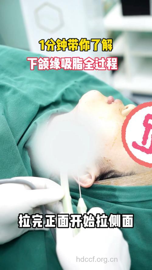 吸脂瘦脸的主要过程