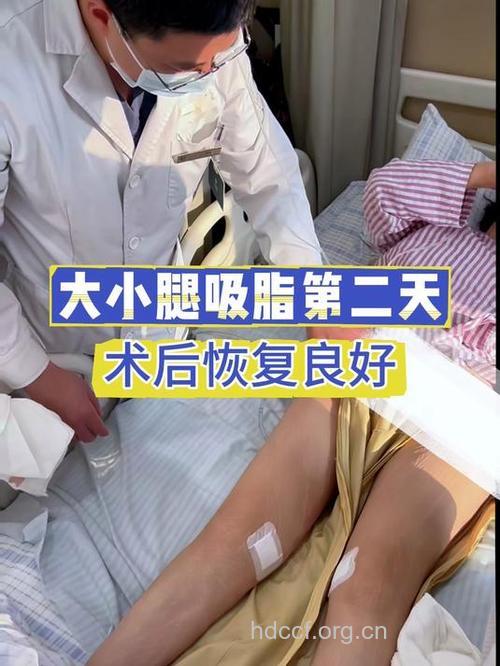 小腿吸脂手术恢复时间