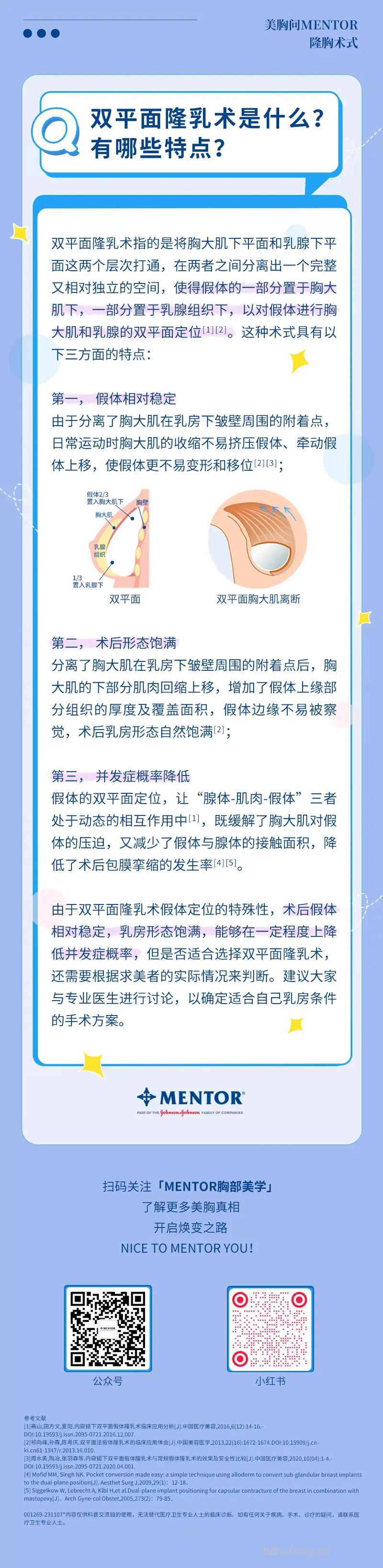 什么是双平面隆乳术