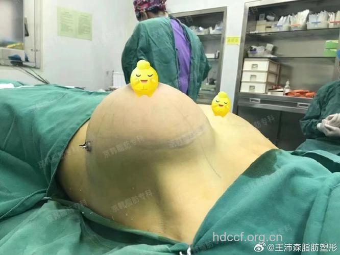 什么是自体脂肪隆胸