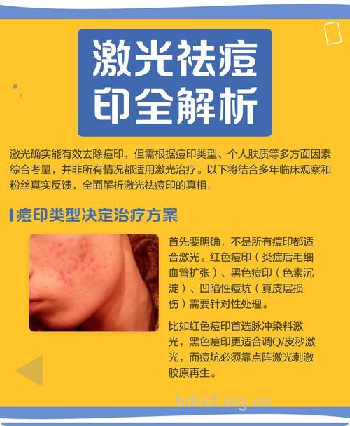 激光祛痘有什么优点