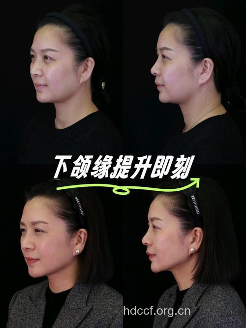 哪些因素影响下颌角整形效果