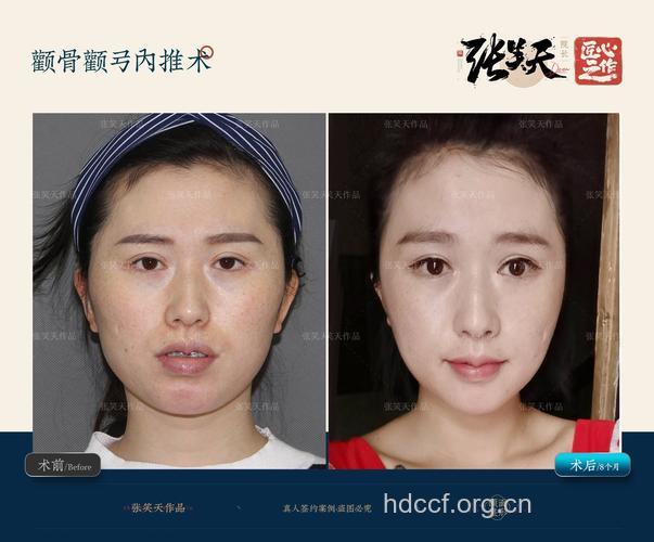 颧骨整形有哪些手术特点
