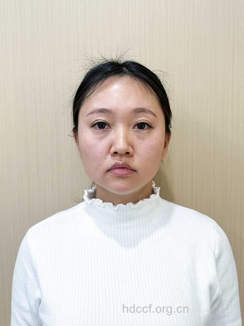 瘦脸整形手术效果怎么样