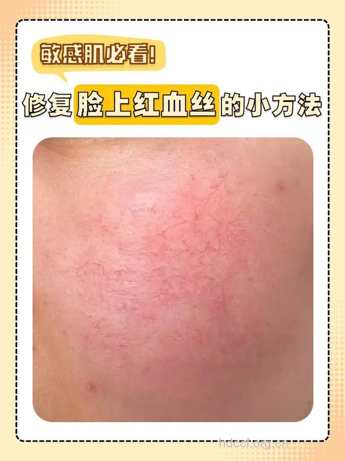 怎样祛除面部红血丝