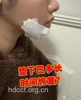垫下巴手术需要多久的恢复期