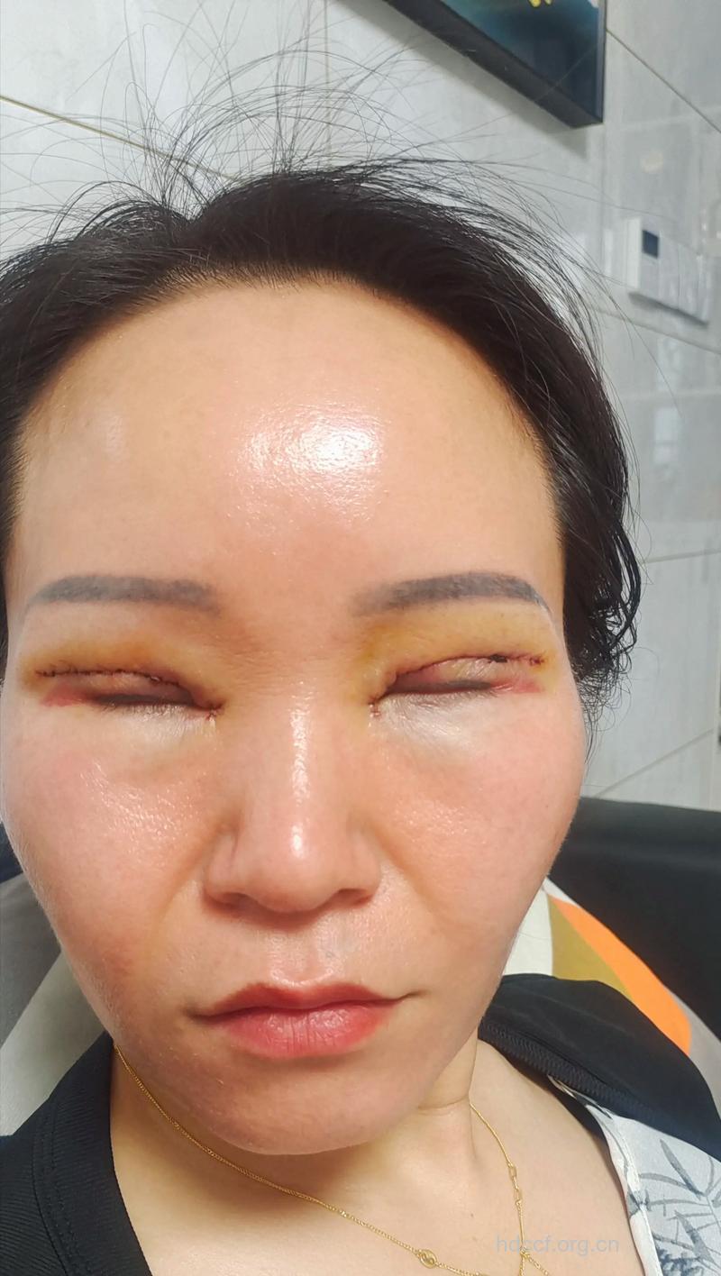 割双眼皮的后遗症有哪些