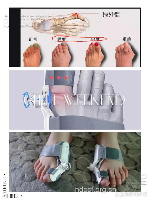 怎么做并指畸形矫正手术