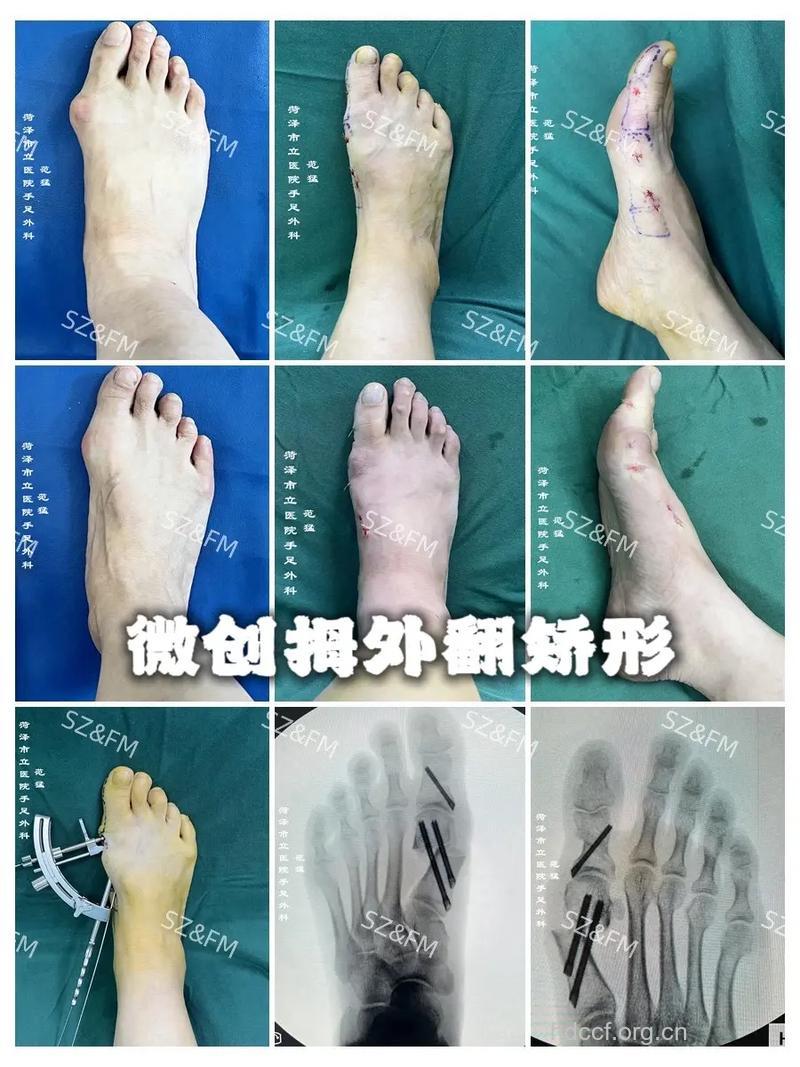 什么是大脚骨微创手术