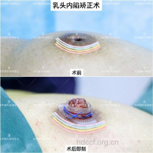 什么是乳头内陷矫正手术