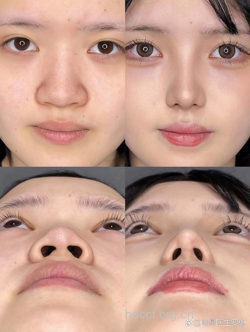 什么是鼻尖塑形手术