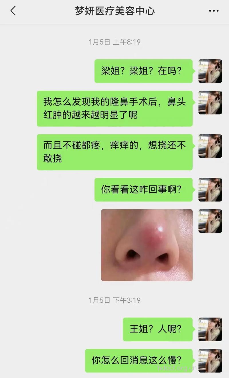 隆鼻手术失败后怎么办