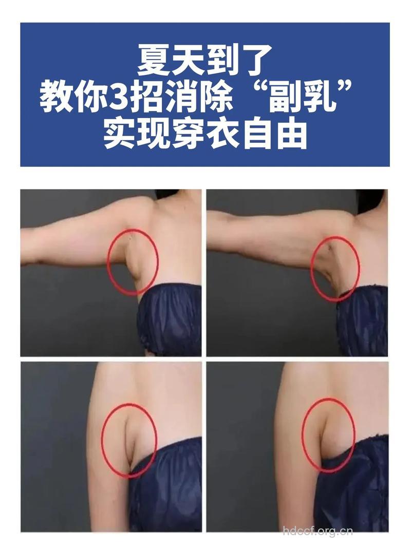 如何切除副乳