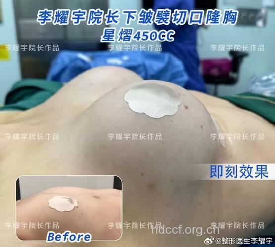 什么是假体隆胸手术