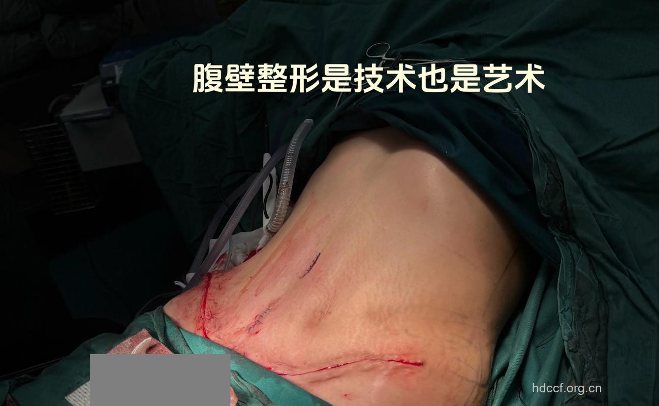 哪种腹部整形术比较好?