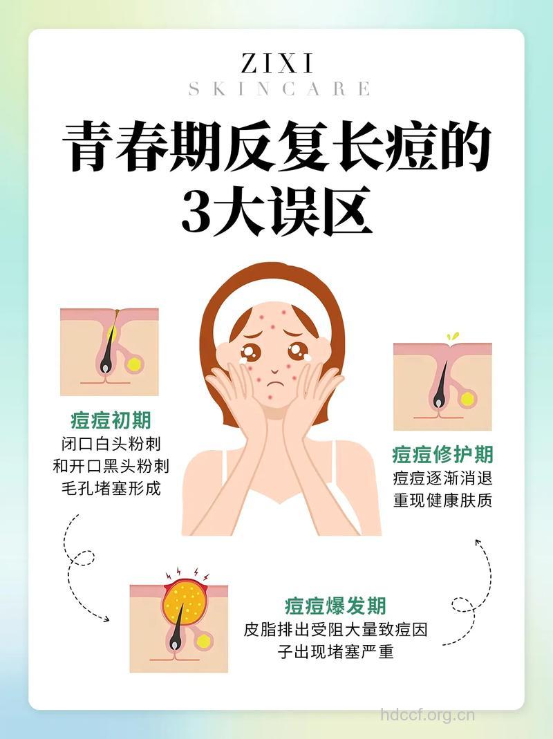 治疗青春痘的三大误区