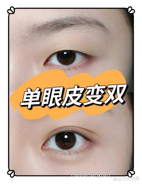 让眼皮变单为双的法宝