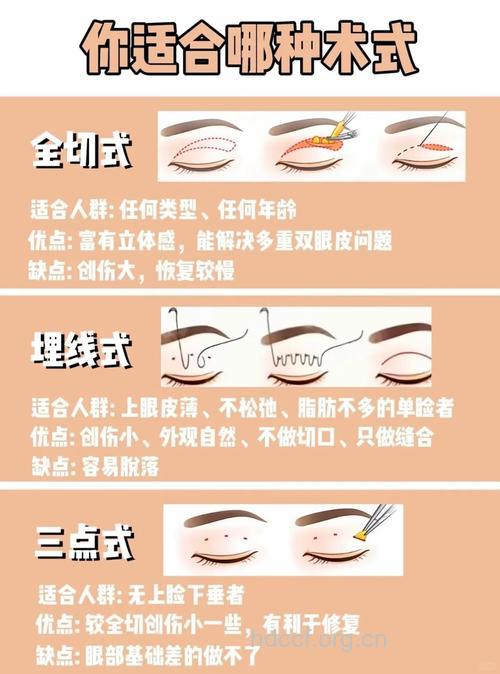 割双眼皮手术有哪此特色