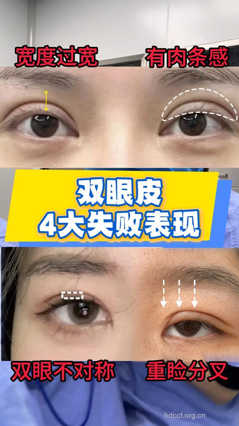 如何应对双眼皮手术失败