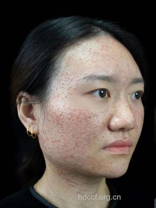 激光祛斑治疗各种皮肤病