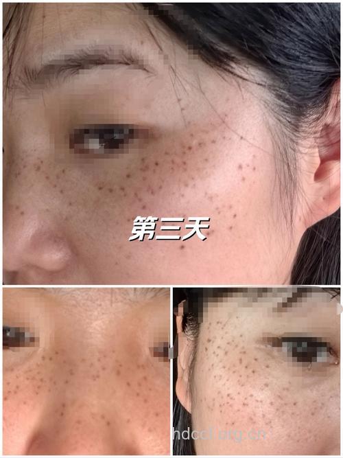 想祛斑试试镭射祛斑吧