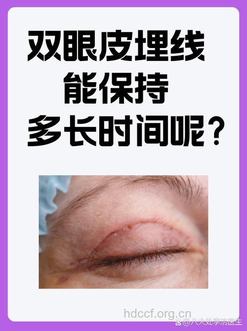 什么是埋线双眼皮手术？