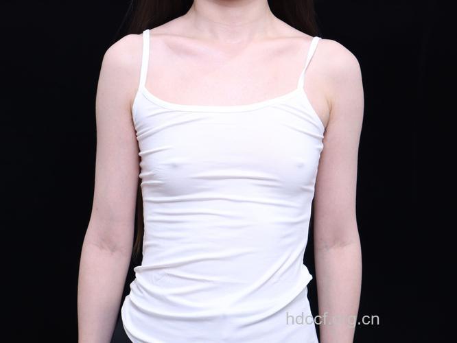 最适合做丰胸手术的物种胸型