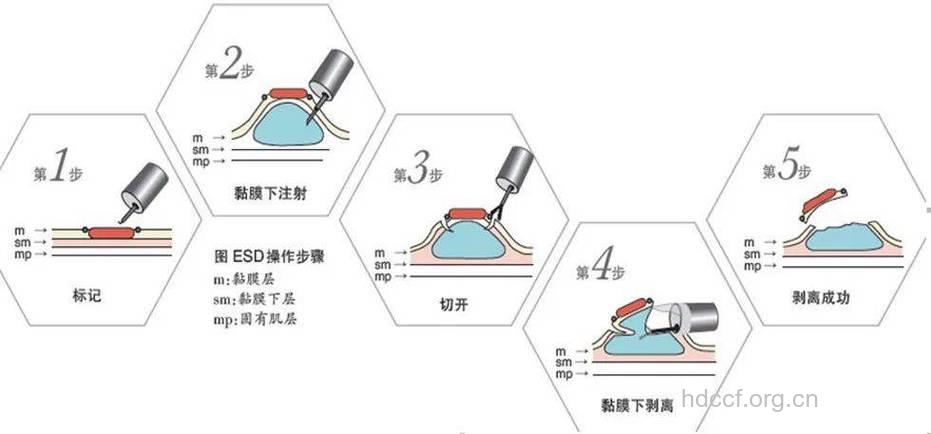 韩式微创的优势