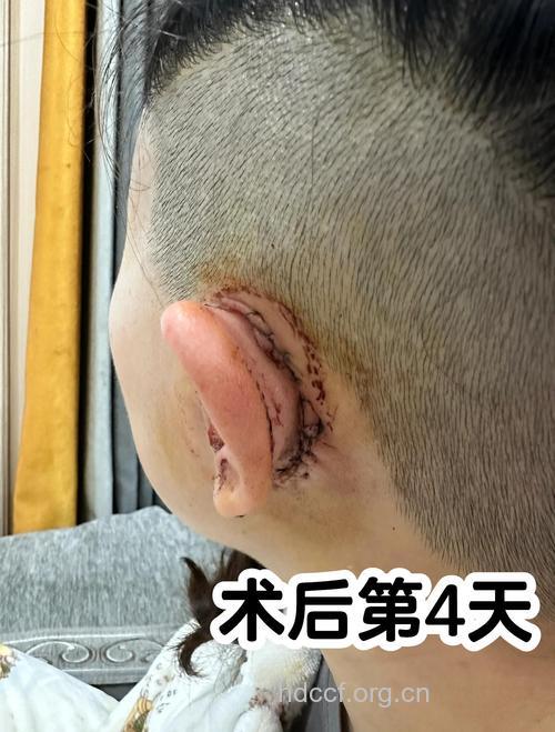 4种常见耳朵整形手术