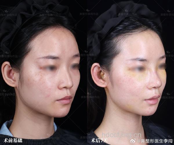 鼻部整形术前术后很关键