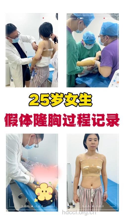 几岁做隆胸手术最好