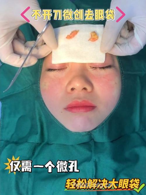 祛眼袋手术有哪些