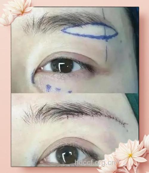 切眉术有哪几种