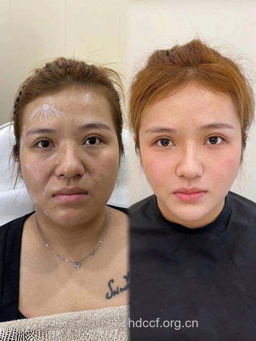 面部填充手术都有哪几种