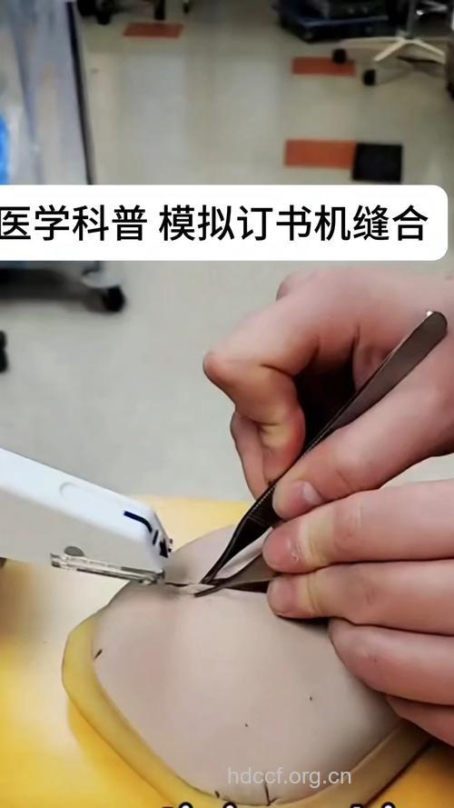 日式订书机式双眼皮手术