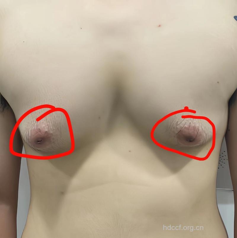 乳头缩小手术改善乳头变黑