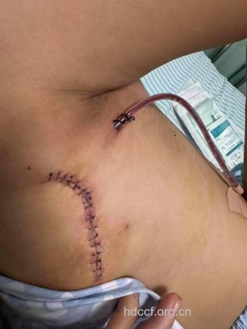 隆胸手术失败让她痛不欲生