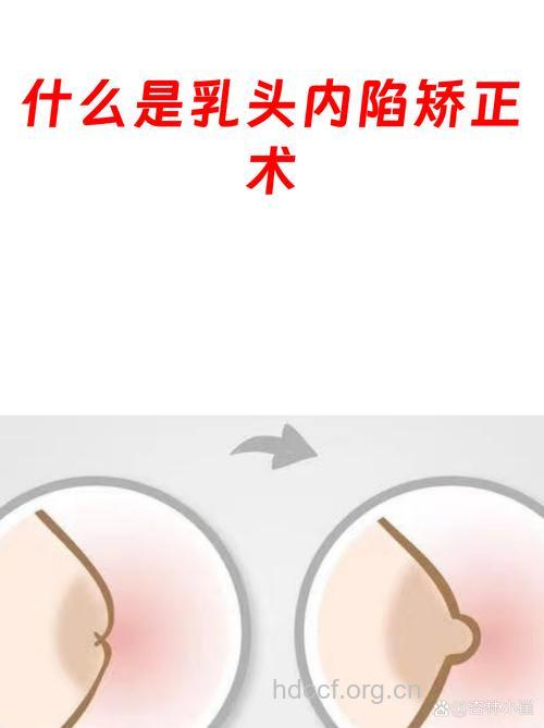 什么是乳头凹陷修复术