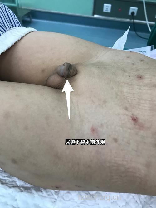 盘点尿道下裂治疗全过程
