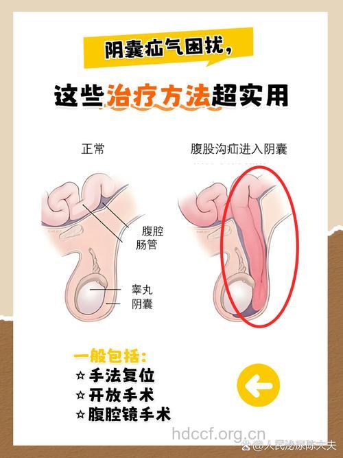男性患疝气要怎么治疗?
