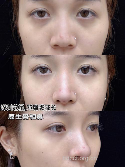 鼻子整形不要忘了鼻尖